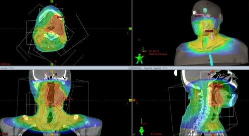 頭頚部IMRT