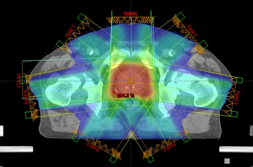 前立腺IMRT